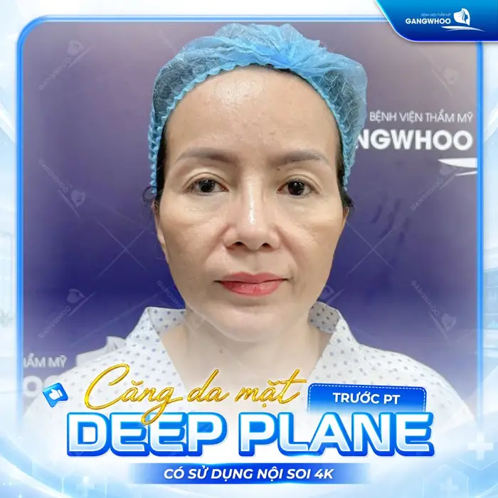 Căng Da Mặt Deep Plane: Giải Pháp Trẻ Hóa Làn Da Toàn Diện & An Toàn 14 ket qua cang da mat deep plane bf 2