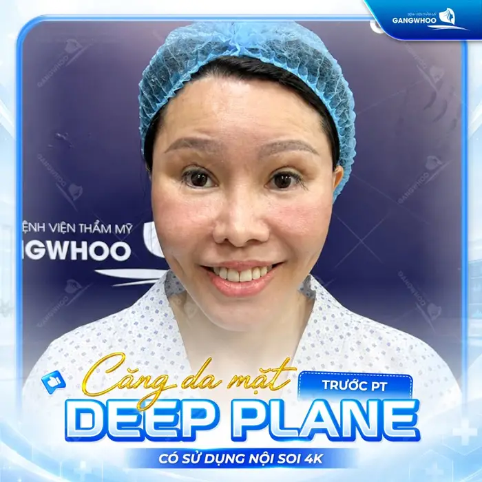Căng Da Mặt Deep Plane: Giải Pháp Trẻ Hóa Làn Da Toàn Diện & An Toàn 12 ket qua cang da mat deep plane bf 3