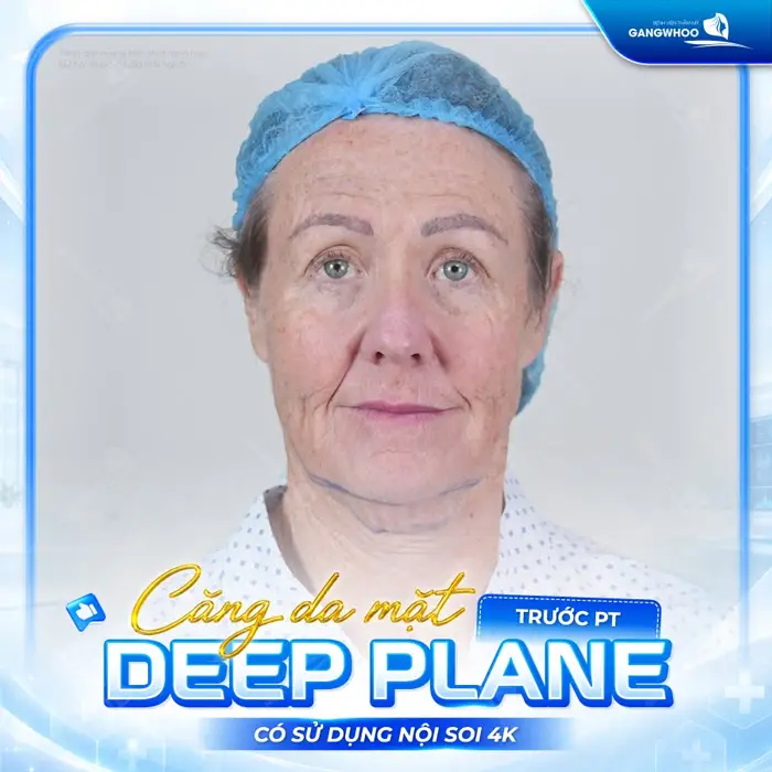 Căng Da Mặt Deep Plane: Giải Pháp Trẻ Hóa Làn Da Toàn Diện & An Toàn 8 ket qua cang da mat deep plane bf 4