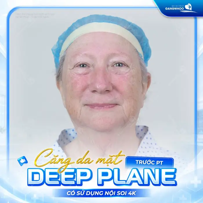 Căng Da Mặt Deep Plane: Giải Pháp Trẻ Hóa Làn Da Toàn Diện & An Toàn 10 ket qua cang da mat deep plane bf 5