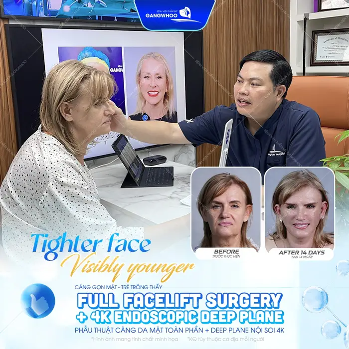 Phẫu thuật căng da mặt toàn phần Deep Plane giải pháp trẻ hóa gương mặt toàn diện và an toàn