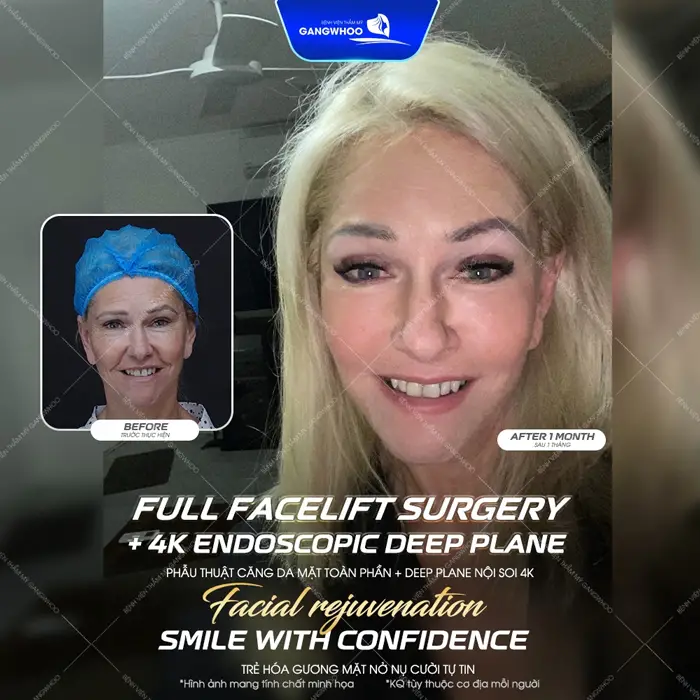 Phẫu thuật căng da mặt toàn phần Deep Plane nội soi 4K trẻ hóa gương mặt an toàn và đẹp dài lâu