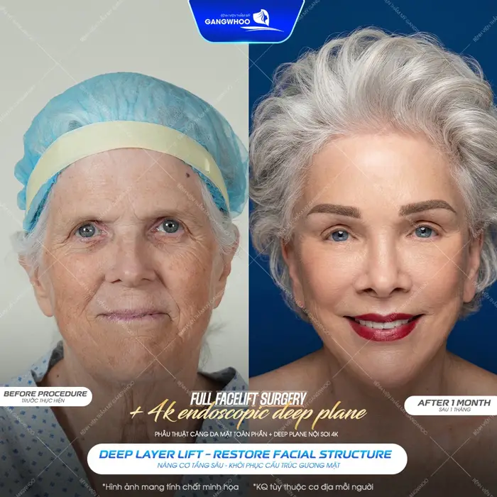 Phẫu thuật căng da mặt Deep Plane ứng dụng nội soi 4K hiện đại sau 1 tháng làn da trẻ đẹp đến bất ngờ