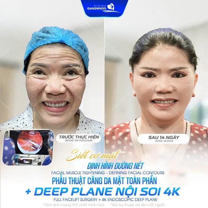 Siết cơ mặt định hình đườn gnét phẫu thuật căng da mặt tàon phần Deep Plane nội soi 4K