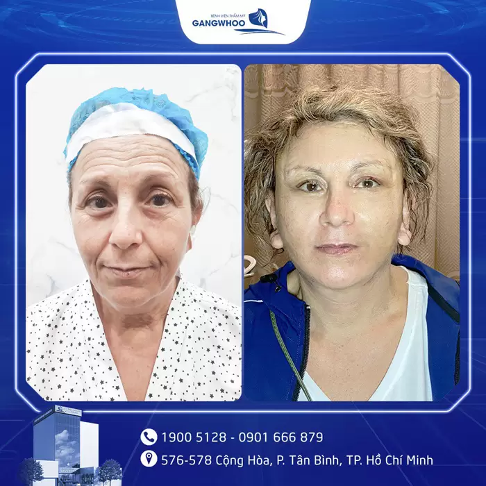 Gangwhoo Cosmetic Hospital - The True Korean Beauty Destination 52 cang da mat 2