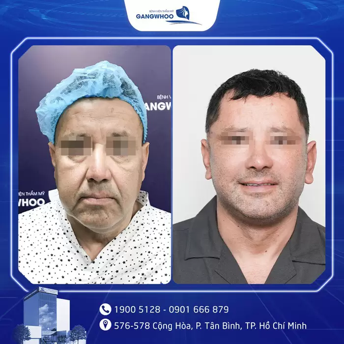 Gangwhoo Cosmetic Hospital - The True Korean Beauty Destination 50 cang da mat 5