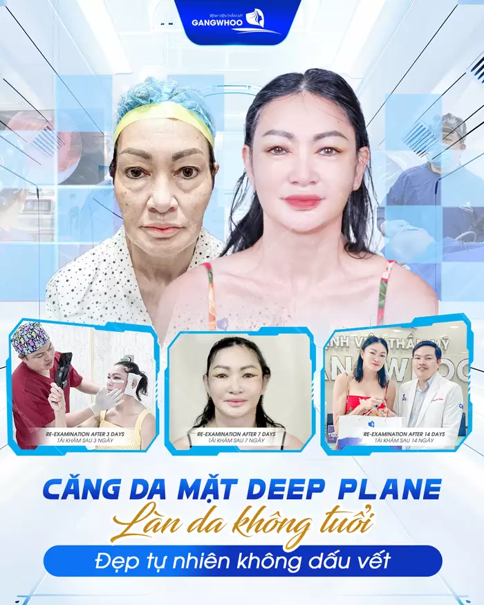 Căng Da Mặt Deep Plane: Giải Pháp Trẻ Hóa Làn Da Toàn Diện & An Toàn