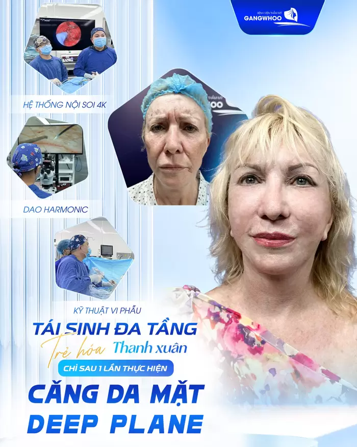 Căng Da Mặt Deep Plane: Giải Pháp Trẻ Hóa Làn Da Toàn Diện & An Toàn
