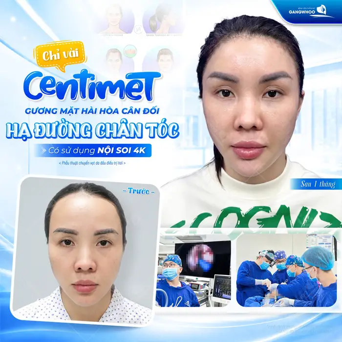 Chỉ vài centimet gương mặt hài hòa cân đối hạ đường chân tóc sử dụng nội soi 4K nét mặt thêm cân đối và hài hòa