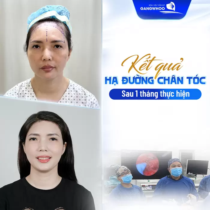 Hạ Đường Chân Tóc Có Bị Rụng Tóc Không? Giải Đáp Từ Bác Sĩ