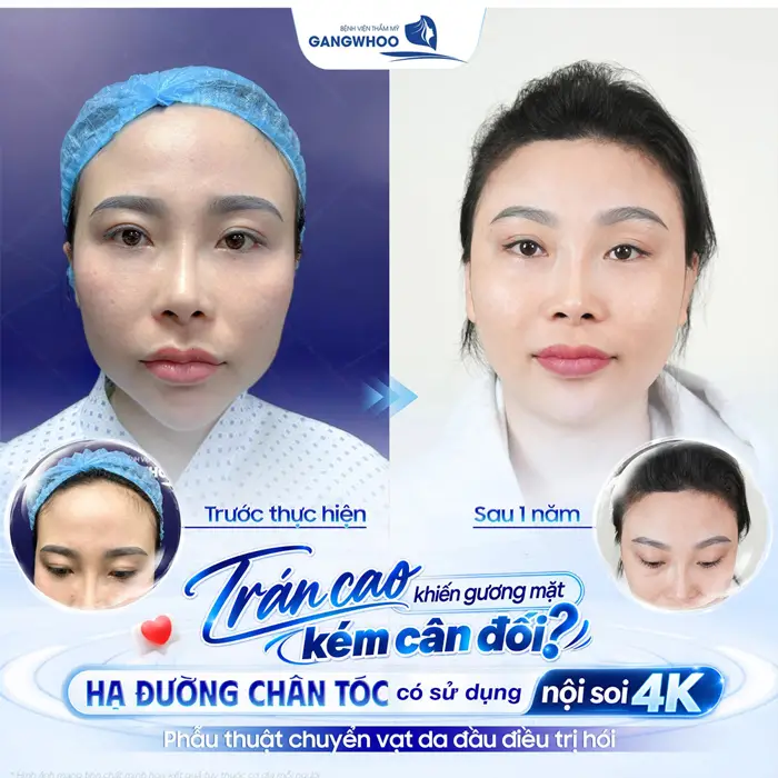 Hạ đường chân tóc có sử dụng nội soi 4K cân chỉnh lại đường chân tóc hài hòa và tự nhiên 