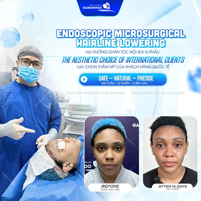 Hạ đường chân tóc nội soi vi phẫu lựa chọn thẩm mỹ được khách hàng quốc tế tin chọn 
