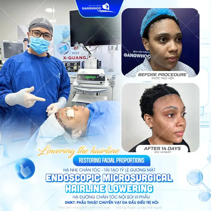 Hạ đường chân tóc tái tạo tỷ lệ gương mặt thêm cân đối, hài hòa và đẹp chuẩn tỷ lệ gương mặt