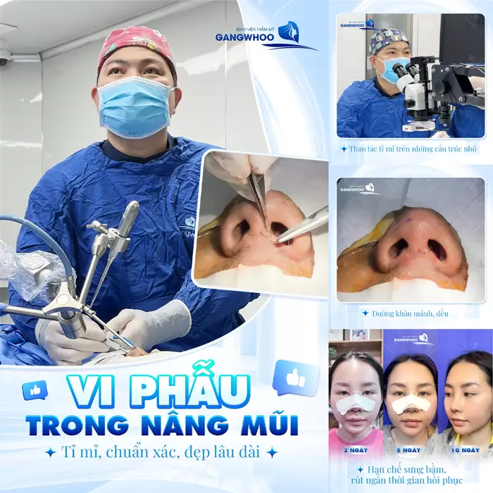 Phẫu Thuật Nâng Mũi Nội Soi 4K Là Gì? Ưu Điểm Và Chi Phí Năm 2025 11 khau vi phau trong nang mui dep ti mi chuan xac va ben lau