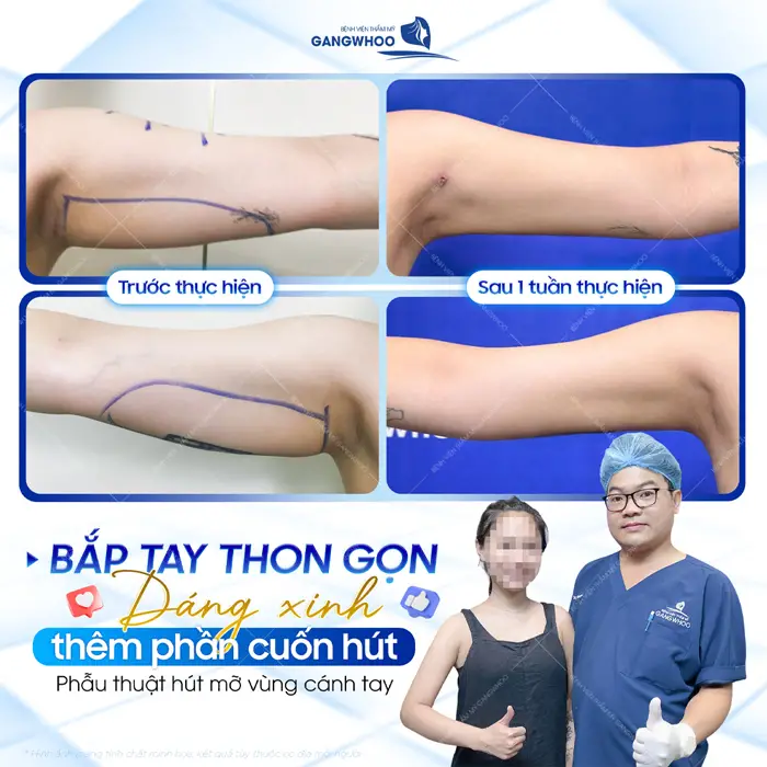 Bắp tay thon gọn dáng xinh thêm phần cuốn hút chỉ 1 tuần hút mỡ vùng cánh tay sự khác biệt đã hoàn toàn rõ rệt