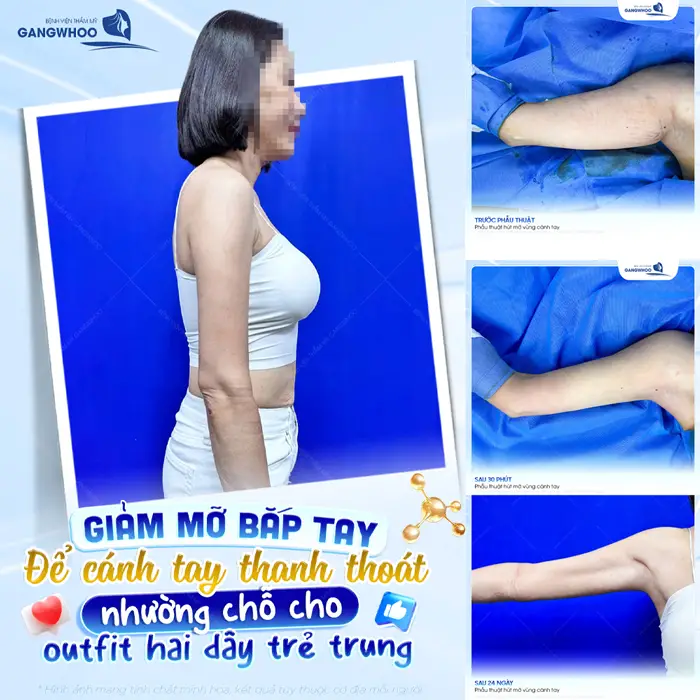 Giảm mỡ cánh tay để cánh tay đẹp thanh thoát nhường chỗ cho outfit hai dây trẻ trung