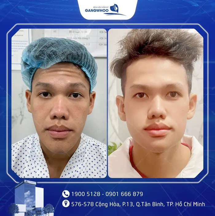 Gọt Hàm Bao Lâu Thì Tháo Nẹp? Hướng Dẫn Chăm Sóc Sau Tháo Nẹp 4 kh got ham noi soi 1