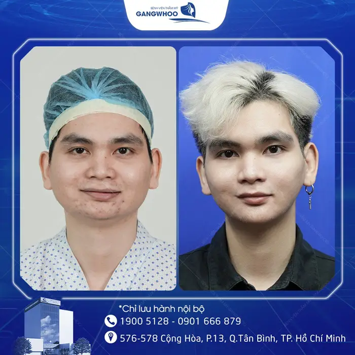 Gọt Hàm Bao Lâu Thì Tháo Nẹp? Hướng Dẫn Chăm Sóc Sau Tháo Nẹp 7 kh got ham noi soi 2