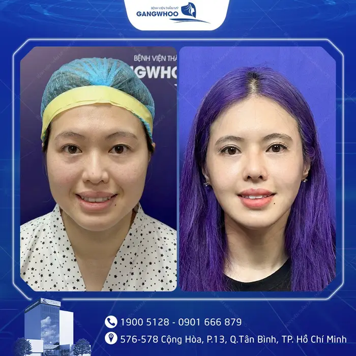 Gọt Hàm Bao Lâu Thì Tháo Nẹp? Hướng Dẫn Chăm Sóc Sau Tháo Nẹp 6 kh got ham noi soi 3