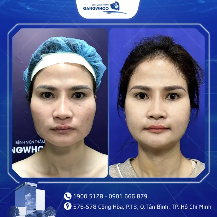 Gọt Hàm Bao Lâu Thì Tháo Nẹp? Hướng Dẫn Chăm Sóc Sau Tháo Nẹp 5 kh got ham noi soi 4