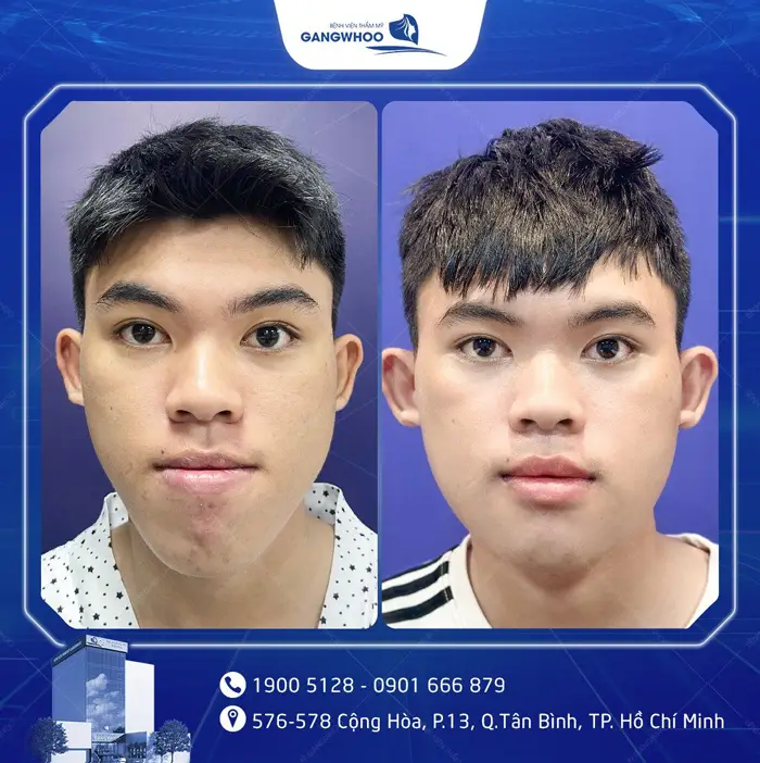 Gọt Hàm Bao Lâu Thì Tháo Nẹp? Hướng Dẫn Chăm Sóc Sau Tháo Nẹp 8 kh got ham noi soi 5