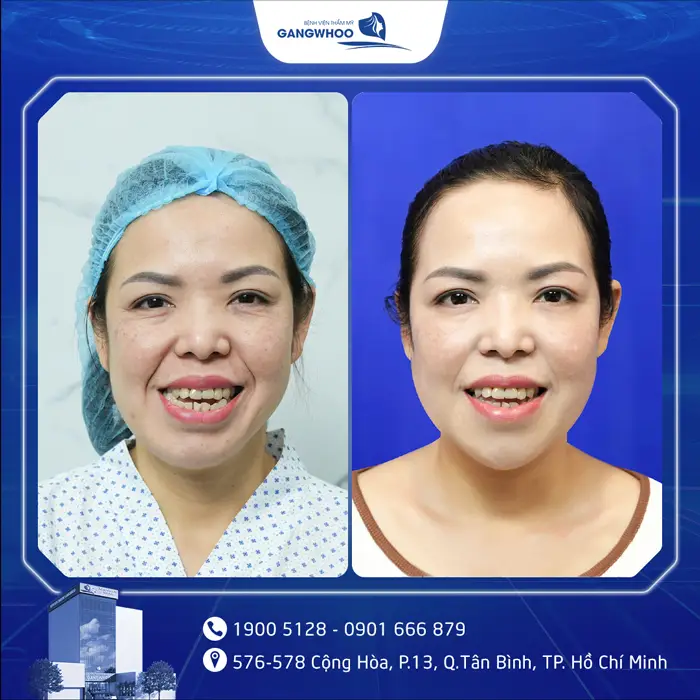 Gọt Hàm Bao Lâu Thì Tháo Nẹp? Hướng Dẫn Chăm Sóc Sau Tháo Nẹp 3 kh got ham noi soi 6