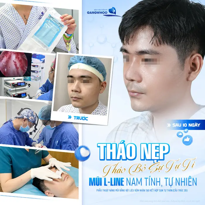 Sau 10 ngày tháo nẹp tháo nẹp mũi cao bay đẹp chuẩn nam tính, an toàn và hiệu quả dài lâu