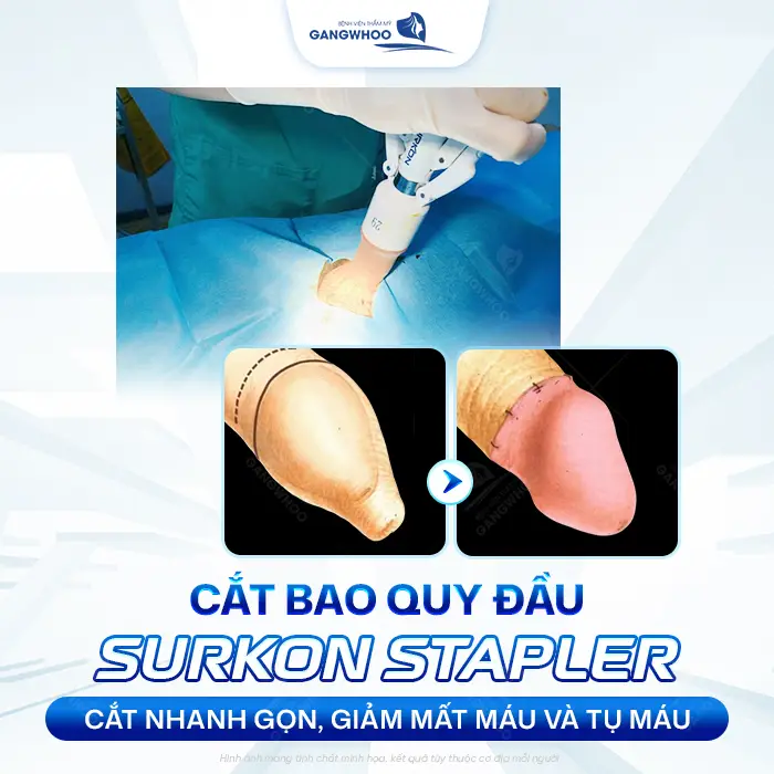 Cắt Bao Quy Đầu Bằng Máy Surkon Stapler – Giải Pháp An Toàn, Nhanh Lành 3 Cắt Bao Quy Đầu Bằng Máy Surkon Stapler – Giải Pháp An Toàn, Nhanh Lành