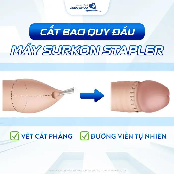 Cắt Bao Quy Đầu Bằng Máy Surkon Stapler – Giải Pháp An Toàn, Nhanh Lành 4 Cắt Bao Quy Đầu Bằng Máy Surkon Stapler – Giải Pháp An Toàn, Nhanh Lành