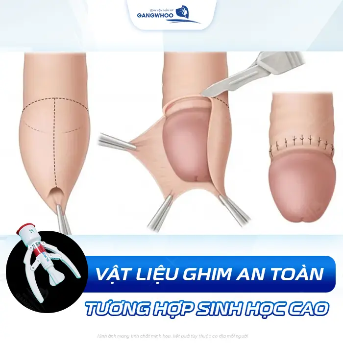 Cắt Bao Quy Đầu Bằng Máy Surkon Stapler – Giải Pháp An Toàn, Nhanh Lành 5 Cắt Bao Quy Đầu Bằng Máy Surkon Stapler – Giải Pháp An Toàn, Nhanh Lành