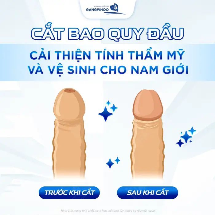 Cắt Bao Quy Đầu Bằng Máy Surkon Stapler – Giải Pháp An Toàn, Nhanh Lành 6 Cắt Bao Quy Đầu Bằng Máy Surkon Stapler – Giải Pháp An Toàn, Nhanh Lành