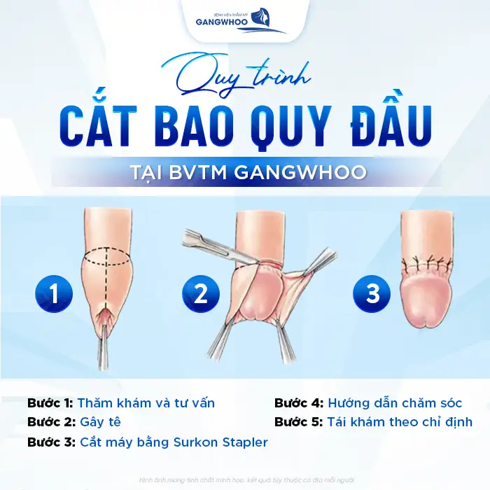 Cắt Bao Quy Đầu Bằng Máy Surkon Stapler – Giải Pháp An Toàn, Nhanh Lành 9 Cắt Bao Quy Đầu Bằng Máy Surkon Stapler – Giải Pháp An Toàn, Nhanh Lành