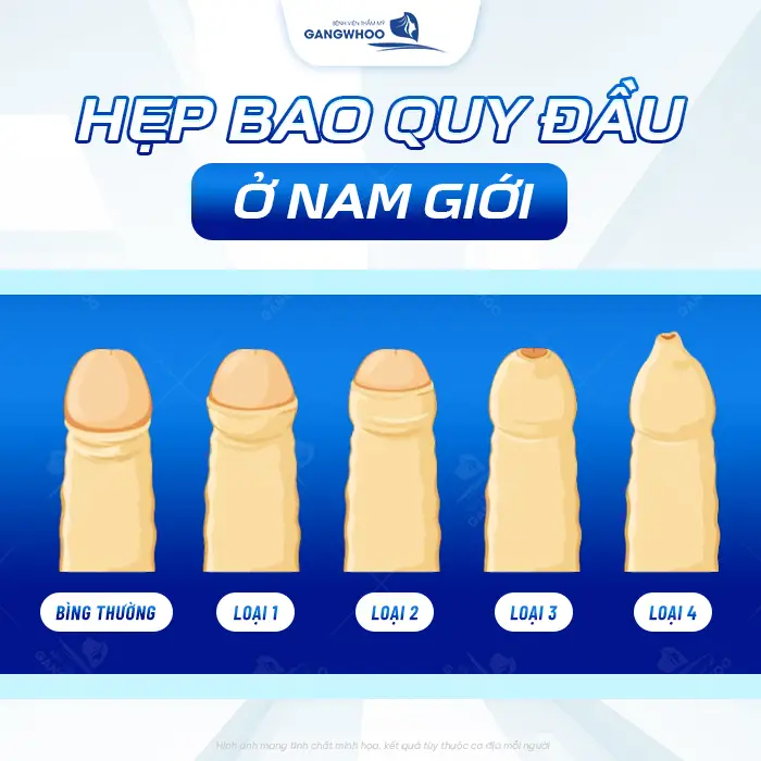 Cắt Bao Quy Đầu Bằng Máy Surkon Stapler – Giải Pháp An Toàn, Nhanh Lành 8 Cắt Bao Quy Đầu Bằng Máy Surkon Stapler – Giải Pháp An Toàn, Nhanh Lành