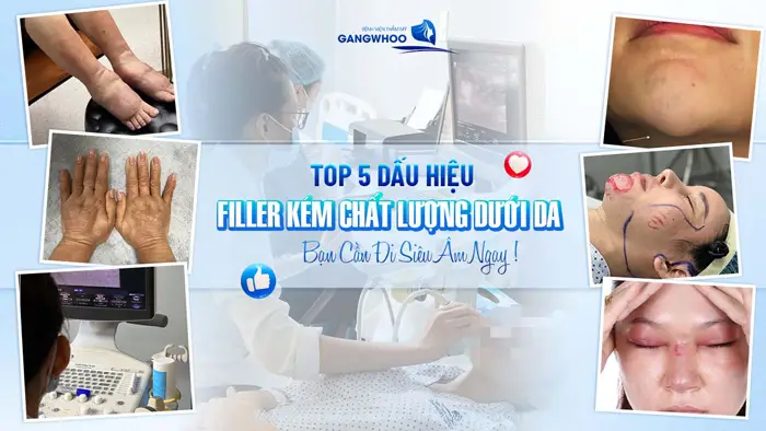 Top 5 Dấu Hiệu Filler Kém Chất Lượng Dưới Da Bạn Cần Đi Siêu Âm Ngay! 1 Top 5 Dấu Hiệu Filler Kém Chất Lượng Dưới Da Bạn Cần Đi Siêu Âm Ngay!