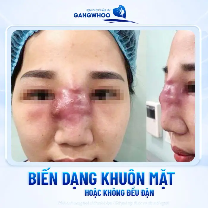Top 5 Dấu Hiệu Filler Kém Chất Lượng Dưới Da Bạn Cần Đi Siêu Âm Ngay! 5 Top 5 Dấu Hiệu Filler Kém Chất Lượng Dưới Da Bạn Cần Đi Siêu Âm Ngay!