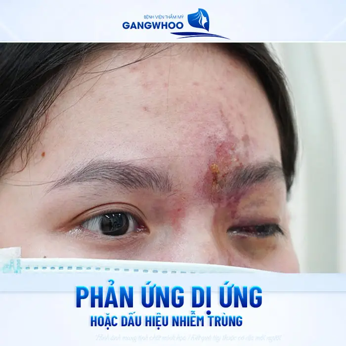 Top 5 Dấu Hiệu Filler Kém Chất Lượng Dưới Da Bạn Cần Đi Siêu Âm Ngay! 6 Top 5 Dấu Hiệu Filler Kém Chất Lượng Dưới Da Bạn Cần Đi Siêu Âm Ngay!