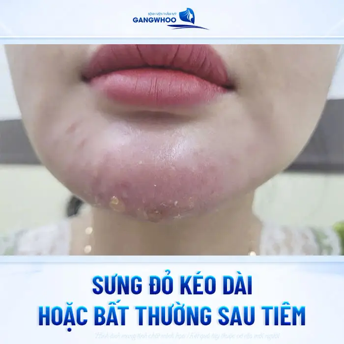 Top 5 Dấu Hiệu Filler Kém Chất Lượng Dưới Da Bạn Cần Đi Siêu Âm Ngay! 2 Top 5 Dấu Hiệu Filler Kém Chất Lượng Dưới Da Bạn Cần Đi Siêu Âm Ngay!