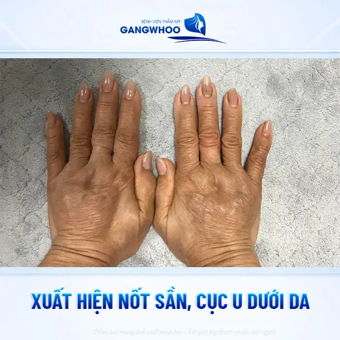 Top 5 Dấu Hiệu Filler Kém Chất Lượng Dưới Da Bạn Cần Đi Siêu Âm Ngay! 3 Top 5 Dấu Hiệu Filler Kém Chất Lượng Dưới Da Bạn Cần Đi Siêu Âm Ngay!