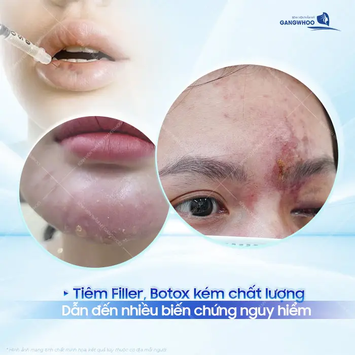Nguy Hiểm Từ Filler, Botox Trôi Nổi - Vì Sao Cần Kiểm Tra Ngay? 2 Nguy Hiểm Từ Filler, Botox Trôi Nổi - Vì Sao Cần Kiểm Tra Ngay?