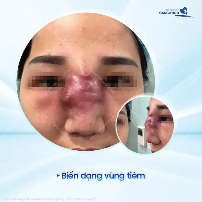 Nguy Hiểm Từ Filler, Botox Trôi Nổi - Vì Sao Cần Kiểm Tra Ngay? 3 Nguy Hiểm Từ Filler, Botox Trôi Nổi - Vì Sao Cần Kiểm Tra Ngay?