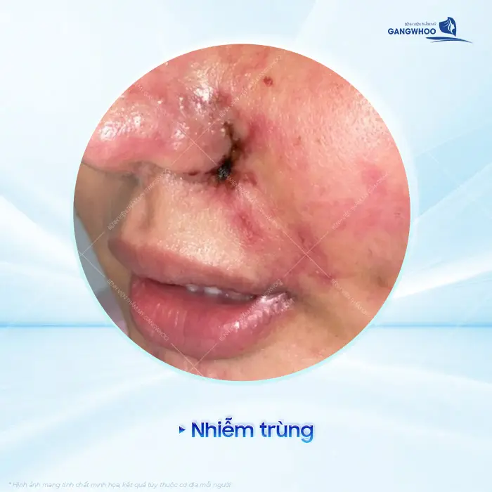 Nguy Hiểm Từ Filler, Botox Trôi Nổi - Vì Sao Cần Kiểm Tra Ngay? 4 Nguy Hiểm Từ Filler, Botox Trôi Nổi - Vì Sao Cần Kiểm Tra Ngay?