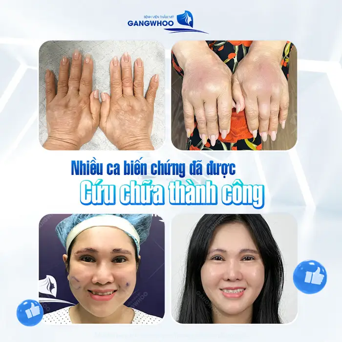 Siêm âm đánh giá tạp chất dưới da cơ hội cho các đối tượng nghi ngờ đã bị tiêm tạp chất vào cơ thể