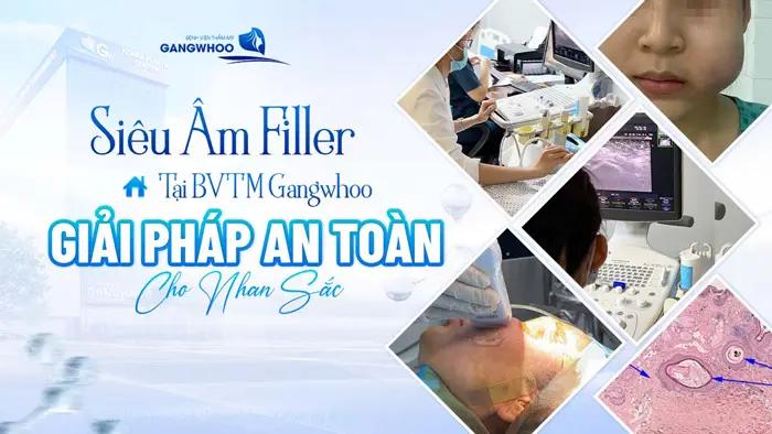 sieu am filler tai bvtm gangwhoo