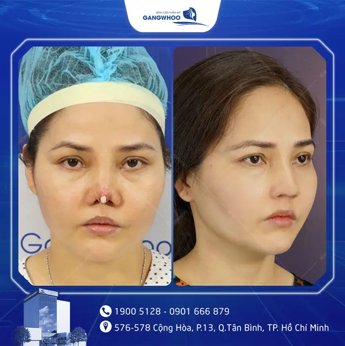 Khách hàng sửa mũi hỏng lòi sụn