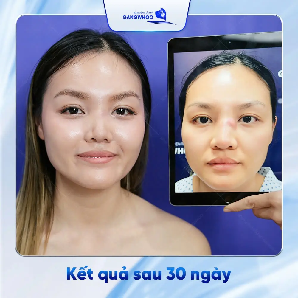 sua mui hong bien chung