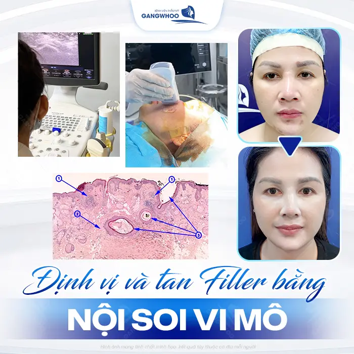 Sửa Mũi Hỏng Do Tiêm Filler Được Không? Bao Lâu Sửa Được? 4 Sửa Mũi Hỏng Do Tiêm Filler Được Không? Bao Lâu Sửa Được?