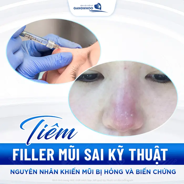 Sửa Mũi Hỏng Do Tiêm Filler Được Không? Bao Lâu Sửa Được? 3 Sửa Mũi Hỏng Do Tiêm Filler Được Không? Bao Lâu Sửa Được?