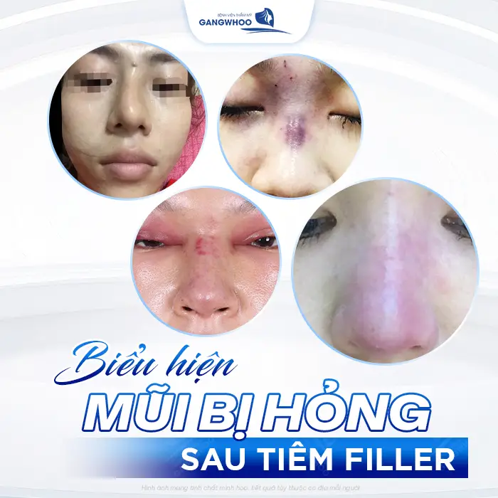 Sửa Mũi Hỏng Do Tiêm Filler Được Không? Bao Lâu Sửa Được? 2 Sửa Mũi Hỏng Do Tiêm Filler Được Không? Bao Lâu Sửa Được?