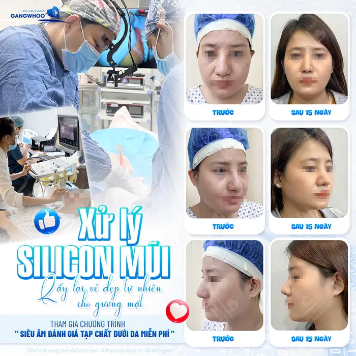 Sửa Mũi Hỏng Do Tiêm Filler Được Không? Bao Lâu Sửa Được? 5 Sửa Mũi Hỏng Do Tiêm Filler Được Không? Bao Lâu Sửa Được?