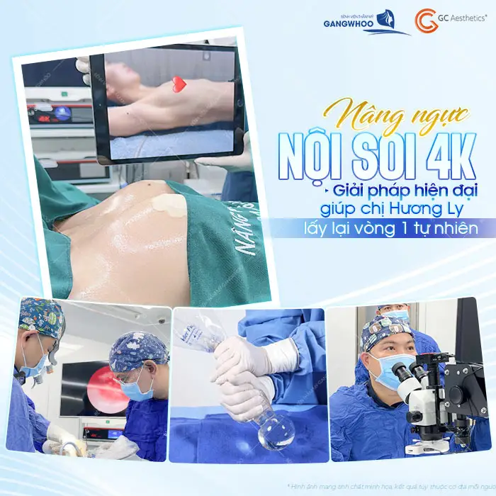 Nâng ngực nội soi 4K giải pháp hiện đại giúp chị Ly lấy lại vòng 1 căng tròn đẹp tự nhiên